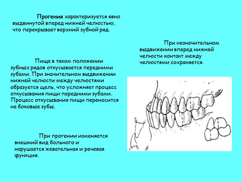 Прогения характеризуется явно выдвинутой вперед нижней челюстью, что перекрывает верхний зубной ряд