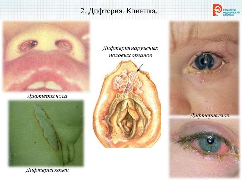 Дифтерия. Клиника. Дифтерия носа