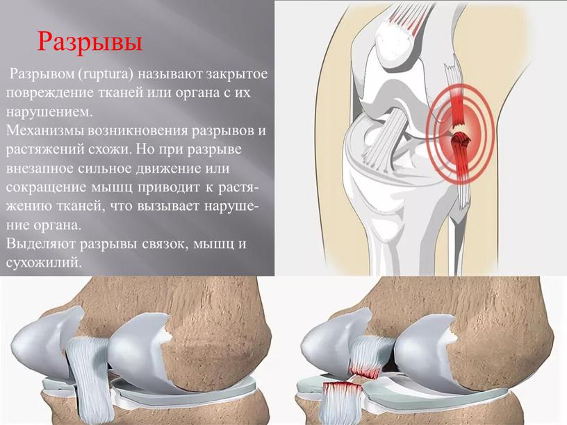 Разрывы Разрывом (ruptura) называют закрытое повреждение тканей или органа с их нарушением