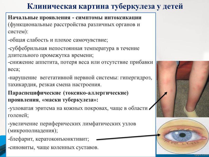 Клиническая картина туберкулеза у детей