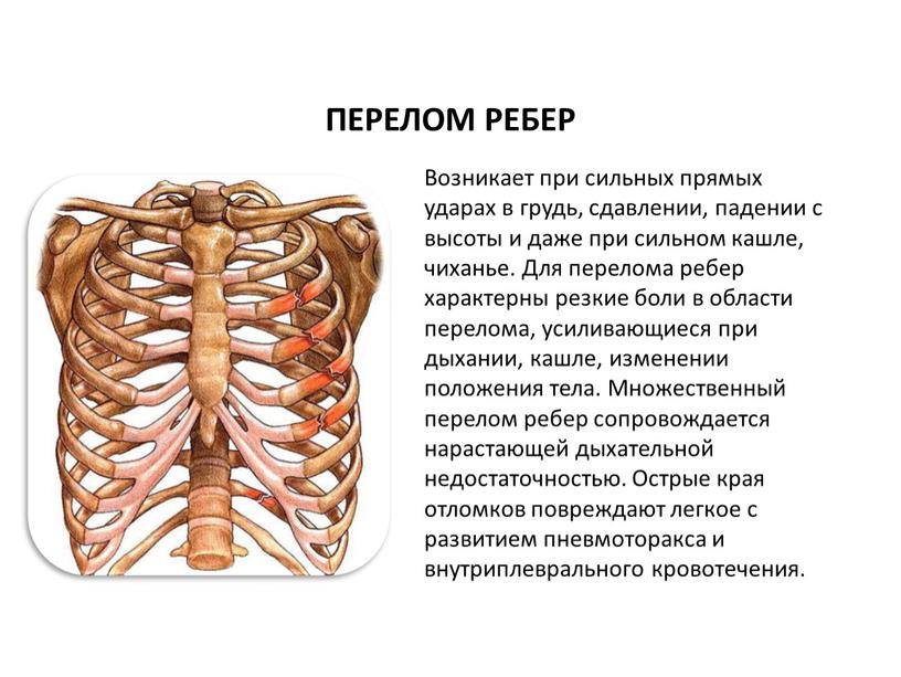 ПЕРЕЛОМ РЕБЕР Возникает при сильных прямых ударах в грудь, сдавлении, падении с высоты и даже при сильном кашле, чиханье