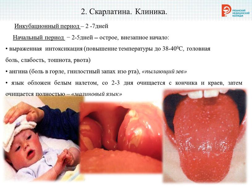 Скарлатина. Клиника. Инкубационный период – 2 -7дней