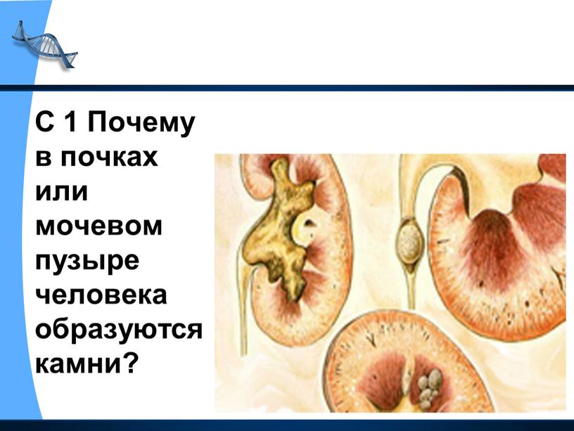 С 1 Почему в почках или мочевом пузыре человека образуются камни?