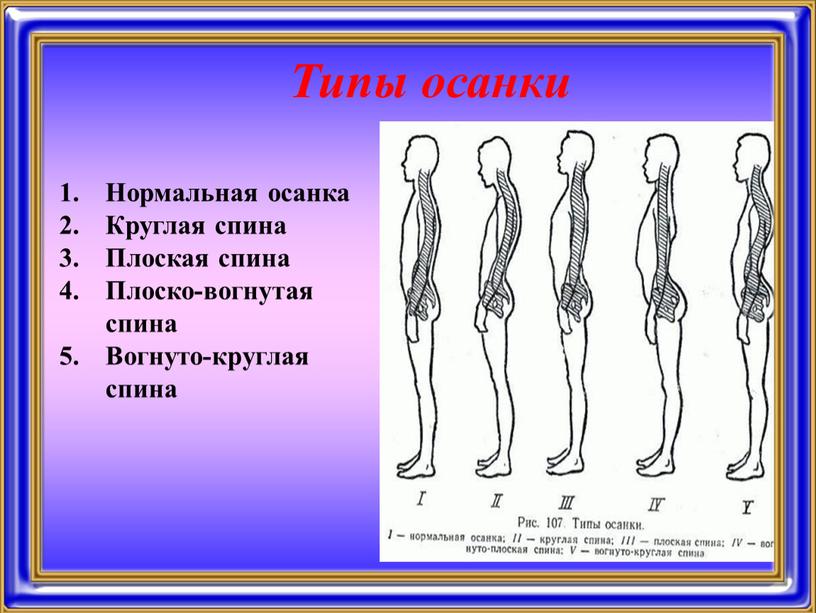 Типы осанки Нормальная осанка Круглая спина