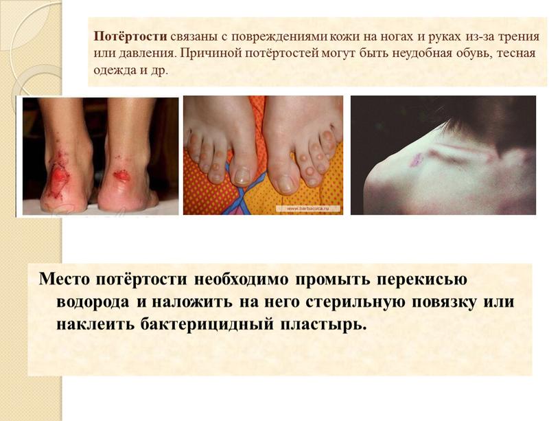 Потёртости связаны с повреждениями кожи на ногах и руках из-за трения или давления