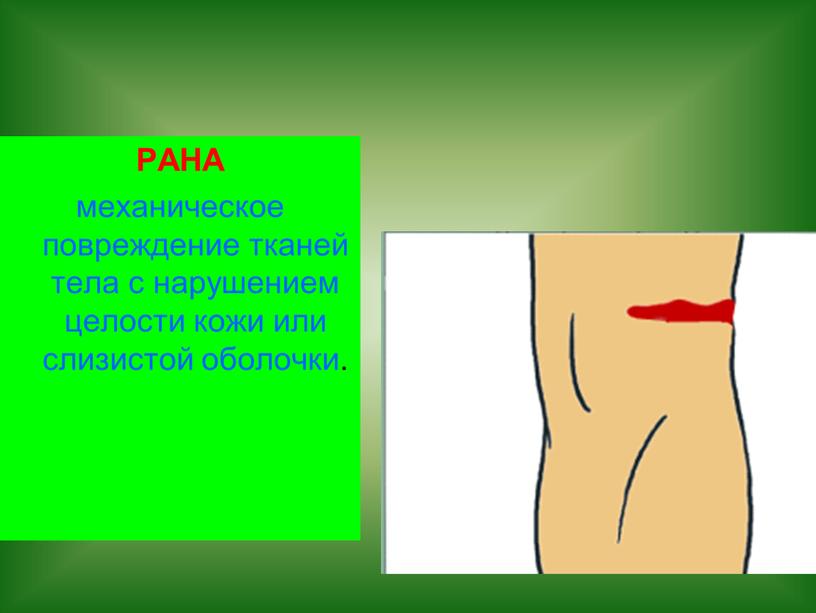 РАНА механическое повреждение тканей тела с нарушением целости кожи или слизистой оболочки