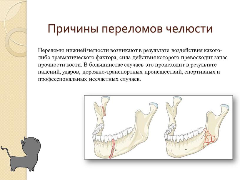Причины переломов челюсти Переломы нижней челюсти возникают в результате воздействия какого-либо травматического фактора, сила действия которого превосходит запас прочности кости