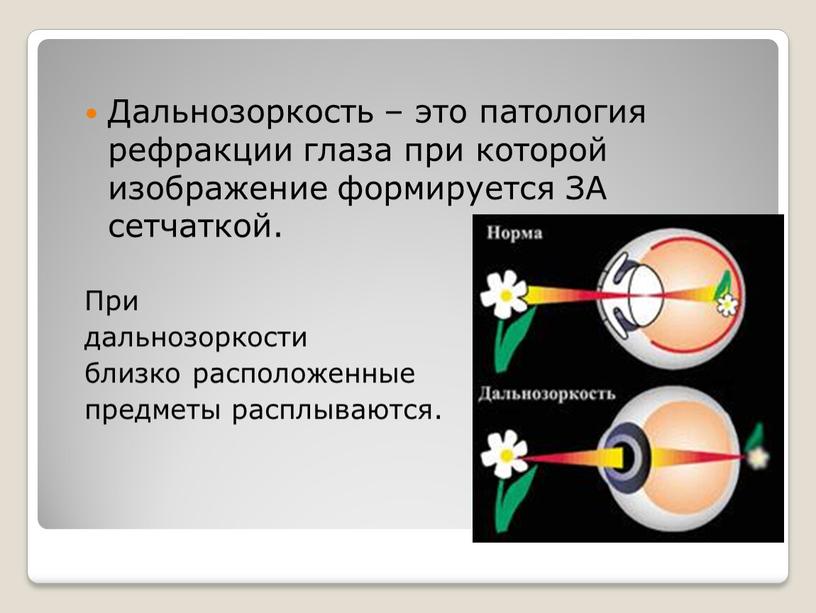 Дальнозоркость – это патология рефракции глаза при которой изображение формируется