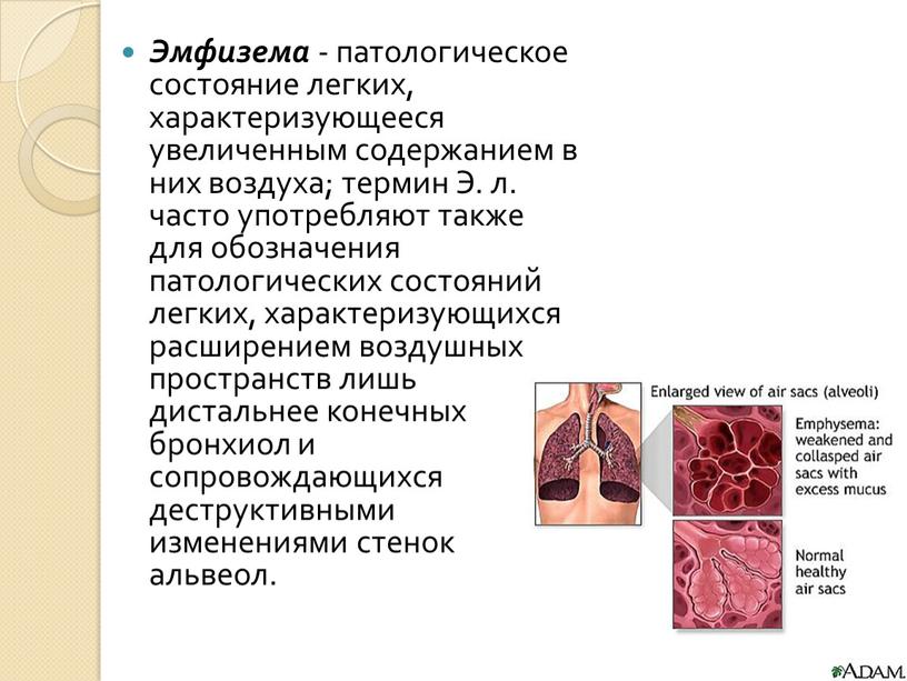 Эмфизема - патологическое состояние легких, характеризующееся увеличенным содержанием в них воздуха; термин