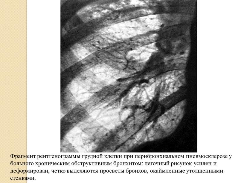 Фрагмент рентгенограммы грудной клетки при перибронхиальном пневмосклерозе у больного хроническим обструктивным бронхитом: легочный рисунок усилен и деформирован, четко выделяются просветы бронхов, окаймленные утолщенными стенками