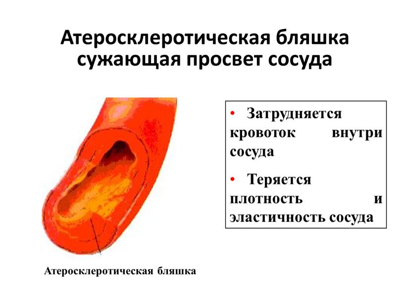 Атеросклеротическая бляшка сужающая просвет сосуда