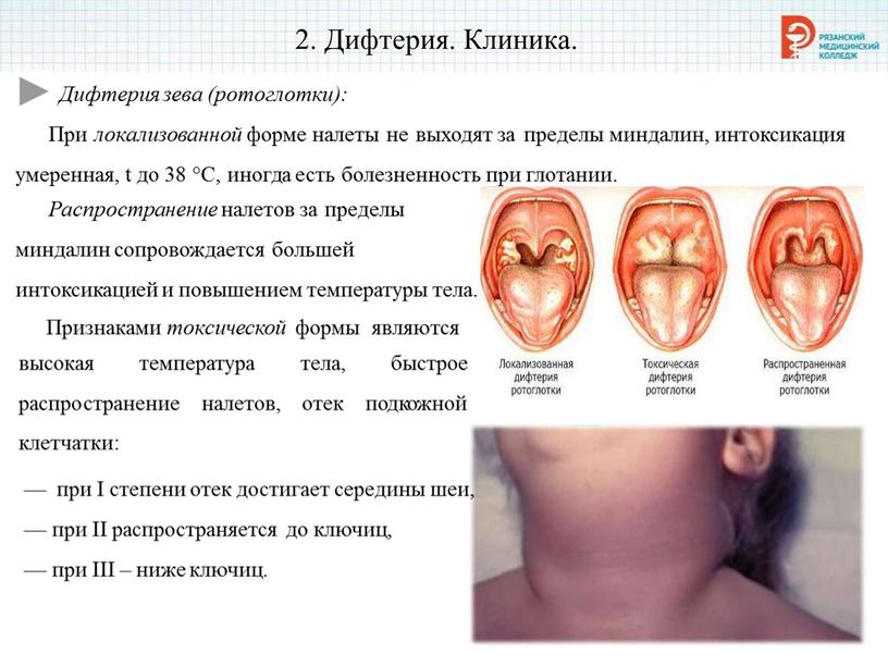 Дифтерия. Клиника. Дифтерия зева (ротоглотки):