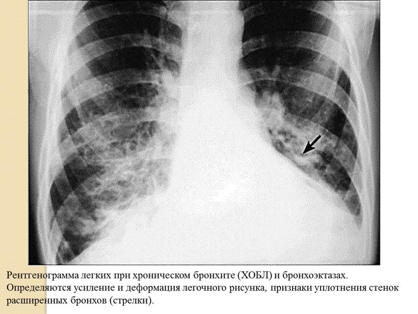 Рентгенограмма легких при хроническом бронхите (ХОБЛ) и бронхоэктазах