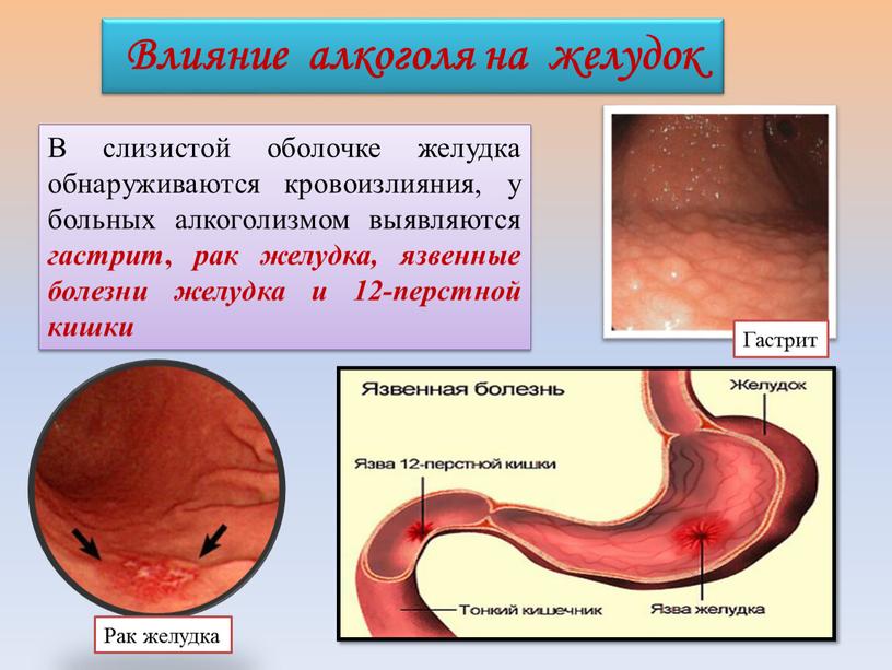 Влияние алкоголя на желудок В слизистой оболочке желудка обнаруживаются кровоизлияния, у больных алкоголизмом выявляются гастрит , рак желудка, язвенные болезни желудка и 12-перстной кишки