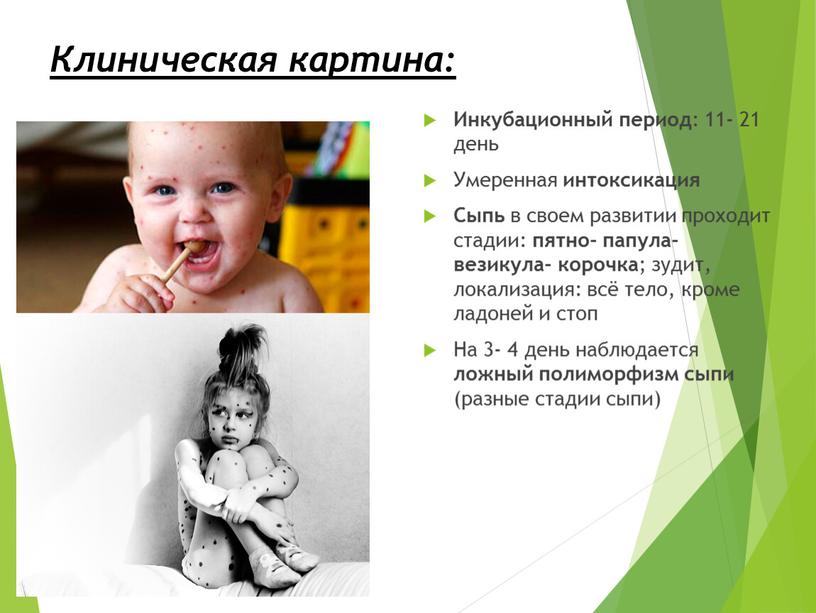 Клиническая картина: Инкубационный период : 11- 21 день