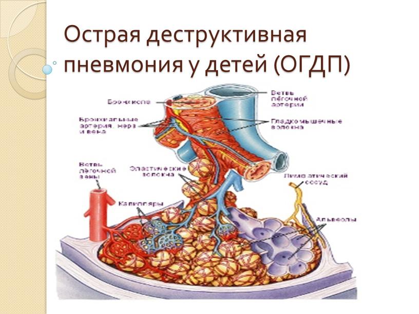 Острая деструктивная пневмония у детей (ОГДП)