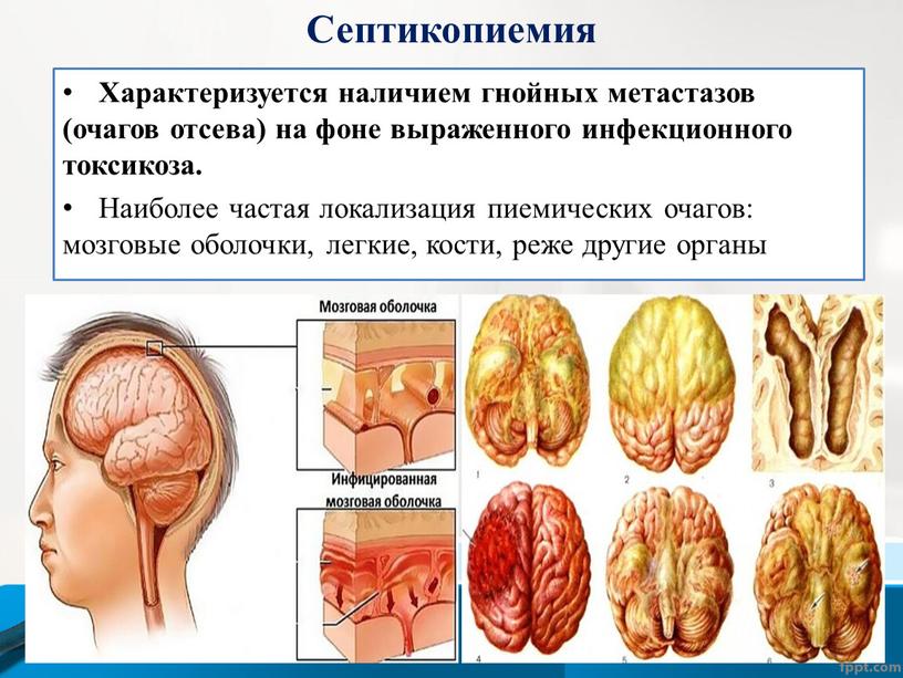 Септикопиемия Характеризуется наличием гнойных метастазов (очагов отсева) на фоне выраженного инфекционного токсикоза