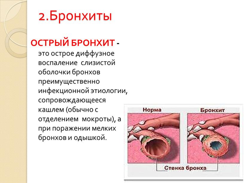 Бронхиты ОСТРЫЙ БРОНХИТ - это острое диффузное воспаление слизистой оболочки бронхов преимущественно инфекционной этиологии, сопровождающееся кашлем (обычно с отделением мокроты), а при поражении мелких бронхов…