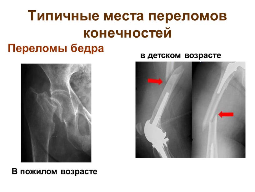 Типичные места переломов конечностей