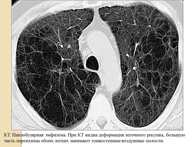 КТ. Панлобулярная эмфизема. При