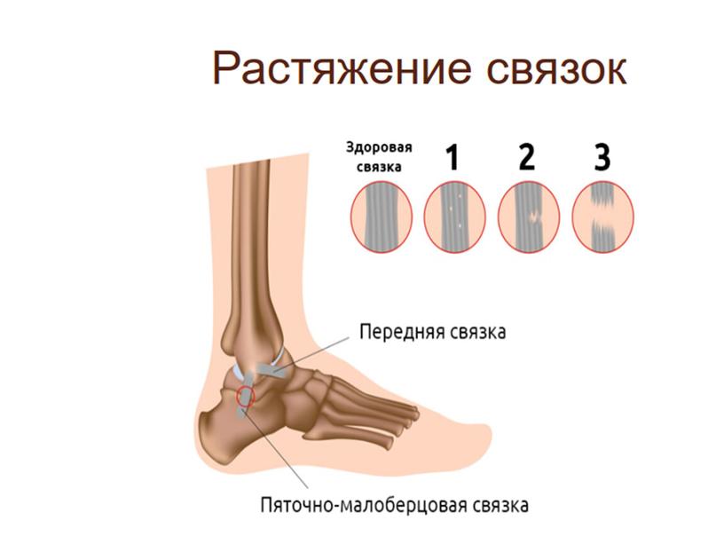 Оказание первой помощи при переломах