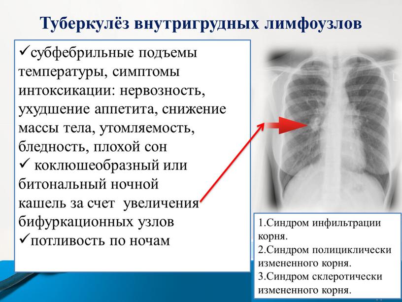 Туберкулёз внутригрудных лимфоузлов субфебрильные подъемы температуры, симптомы интоксикации: нервозность, ухудшение аппетита, снижение массы тела, утомляемость, бледность, плохой сон коклюшеобразный или битональный ночной кашель за счет…