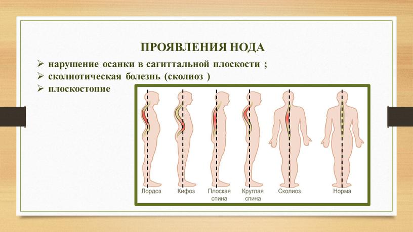 ПРОЯВЛЕНИЯ НОДА нарушение осанки в сагиттальной плоскости ; сколиотическая болезнь (сколиоз ) плоскостопие