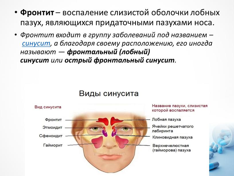 Фронтит – воспаление слизистой оболочки лобных пазух, являющихся придаточными пазухами носа