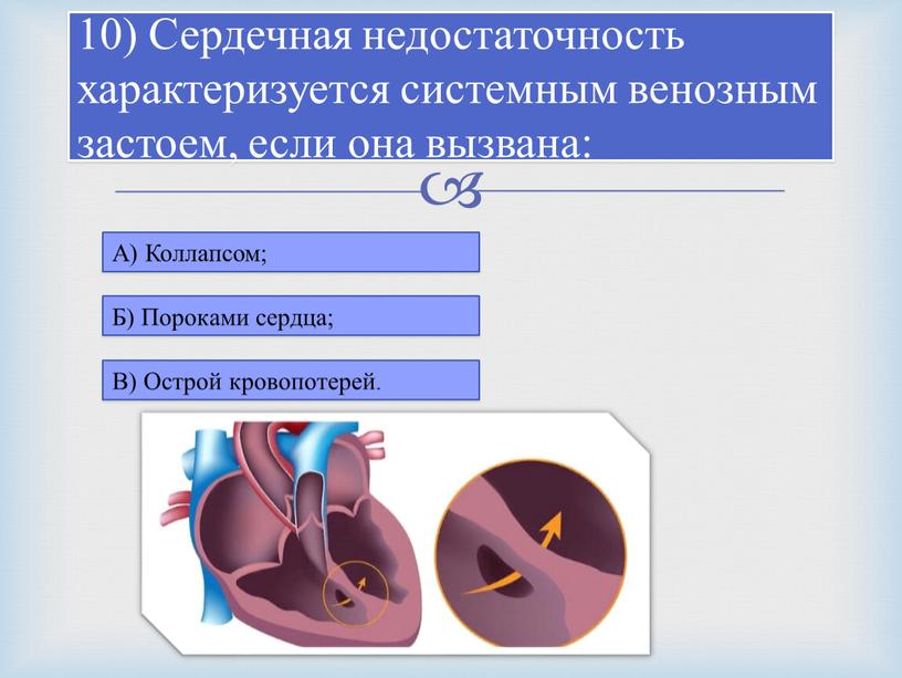 Сердечная недостаточность характеризуется системным венозным застоем, если она вызвана: