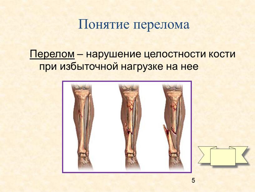 Понятие перелома Перелом – нарушение целостности кости при избыточной нагрузке на нее 5