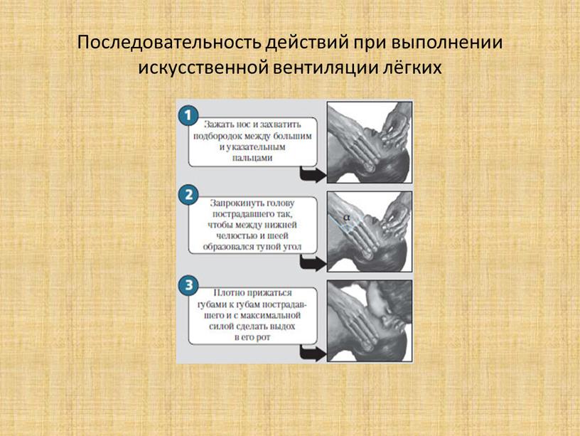 Последовательность действий при выполнении искусственной вентиляции лёгких