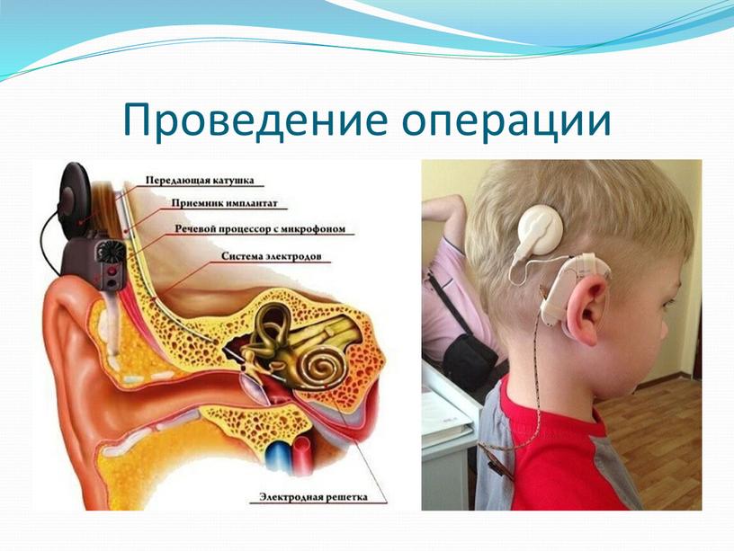 Проведение операции Операция имплантации выполняется под общим наркозом и длится в среднем 1,5 – 2 часа