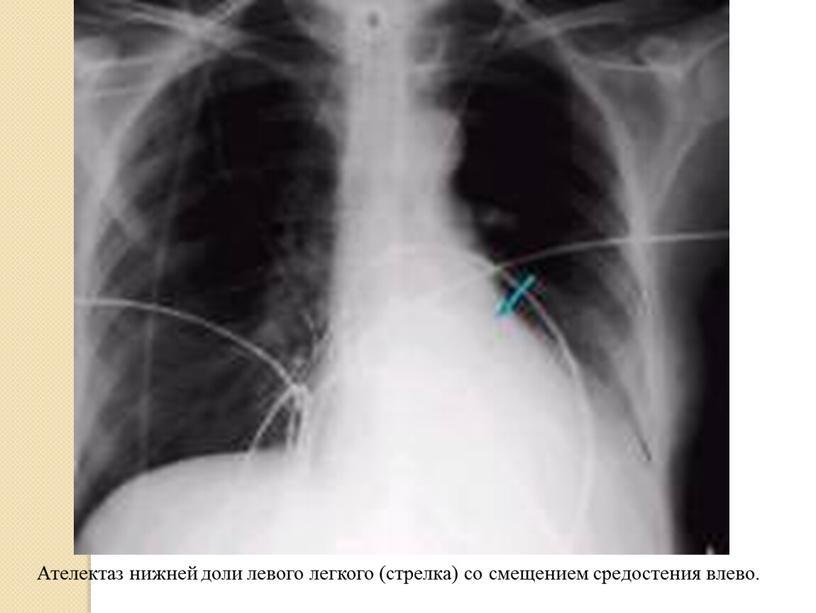 Ателектаз нижней доли левого легкого (стрелка) со смещением средостения влево