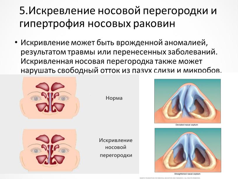 Искревление носовой перегородки и гипертрофия носовых раковин