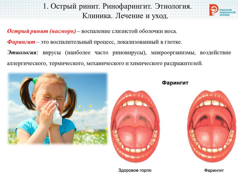 Острый ринит. Ринофарингит. Этиология