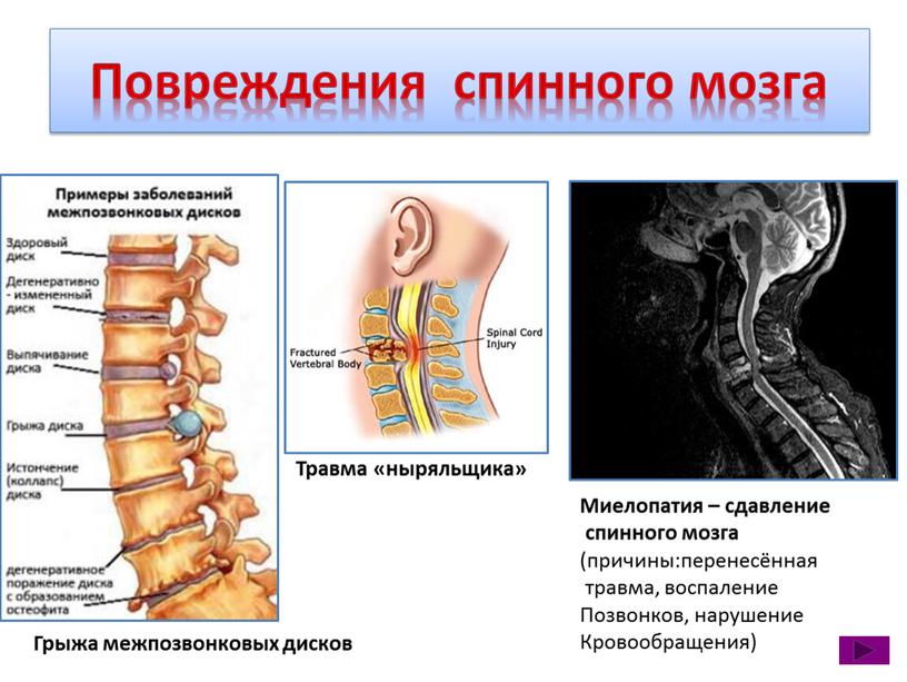 Повреждения спинного мозга Травма «ныряльщика»