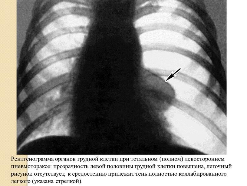 Рентгенограмма органов грудной клетки при тотальном (полном) левостороннем пневмотораксе: прозрачность левой половины грудной клетки повышена, легочный рисунок отсутствует, к средостению прилежит тень полностью коллабированного легкого…