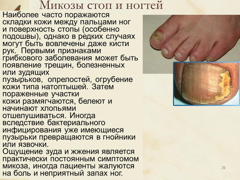 Микозы стоп и ногтей Наиболее часто поражаются складки кожи между пальцами ног и поверхность стопы (особенно подошвы), однако в редких случаях могут быть вовлечены даже…