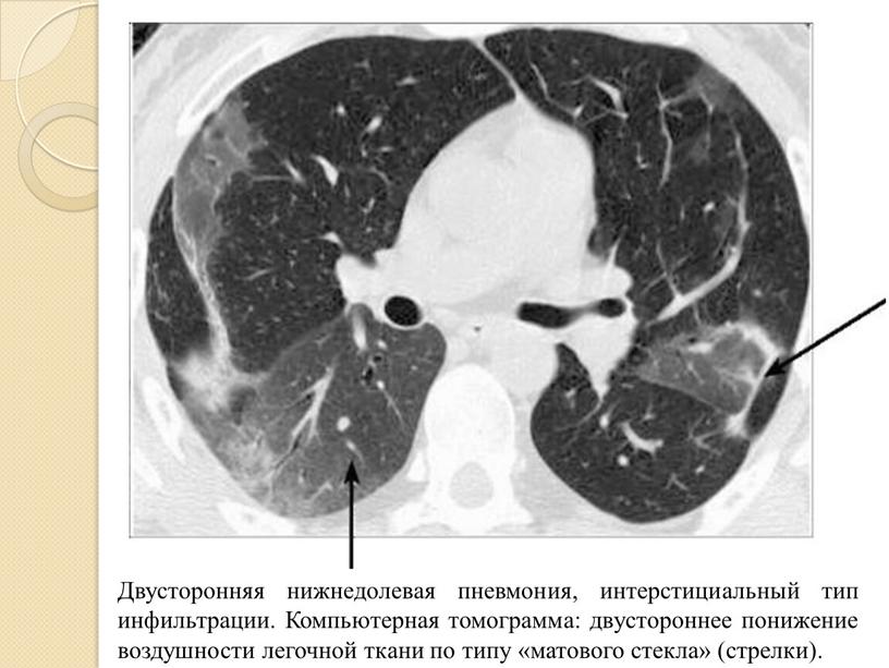 Двусторонняя нижнедолевая пневмония, интерстициальный тип инфильтрации