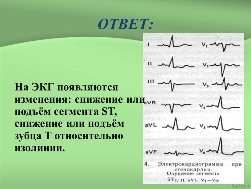 ОТВЕТ: На ЭКГ появляются изменения: снижение или подъём сегмента