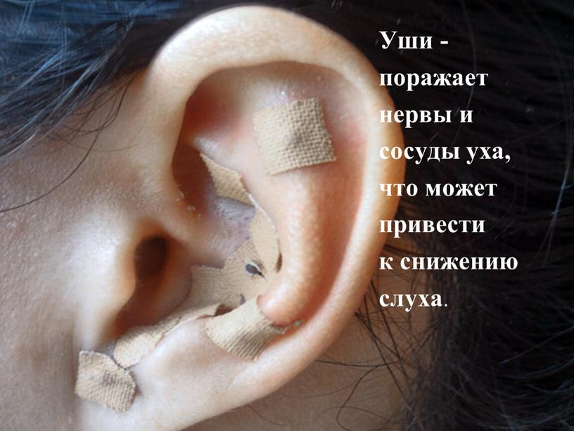 Уши - поражает нервы и сосуды уха, что может привести к снижению слуха