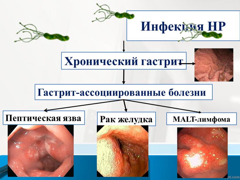 Инфекция НР Хронический гастрит