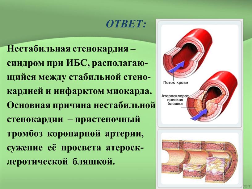 ОТВЕТ: Нестабильная стенокардия – синдром при