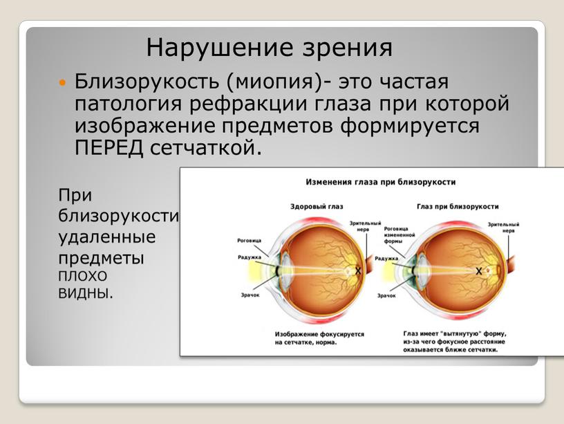 Близорукость (миопия)- это частая патология рефракции глаза при которой изображение предметов формируется