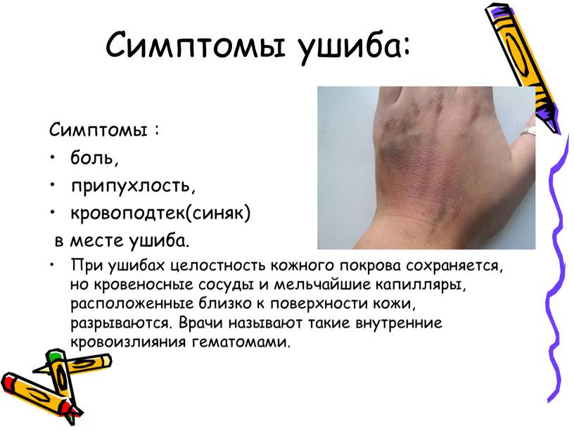 Симптомы ушиба: Симптомы : боль, припухлость, кровоподтек(синяк) в месте ушиба