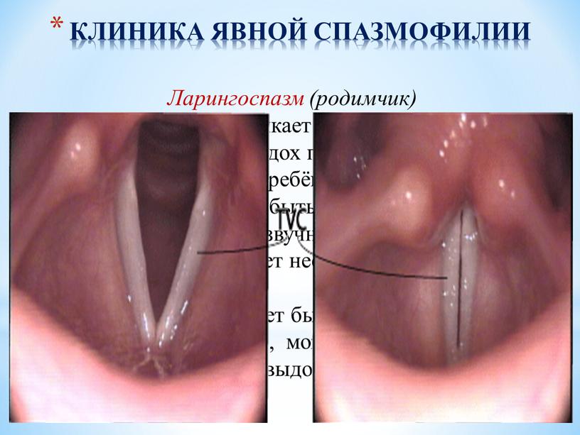 КЛИНИКА ЯВНОЙ СПАЗМОФИЛИИ Ларингоспазм (родимчик) – при плаче, испуге возникает спазм голосовой щели звучный или хриплый вдох при плаче и крике и апноэ на несколько…