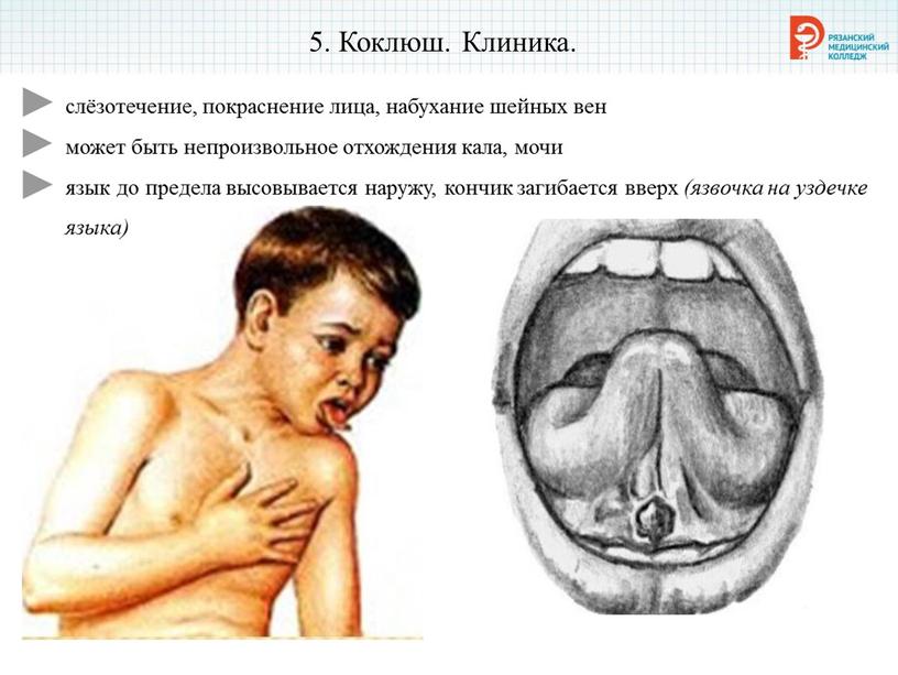 Коклюш. Клиника. слёзотечение, покраснение лица, набухание шейных вен может быть непроизвольное отхождения кала, мочи язык до предела высовывается наружу, кончик загибается вверх (язвочка на уздечке…