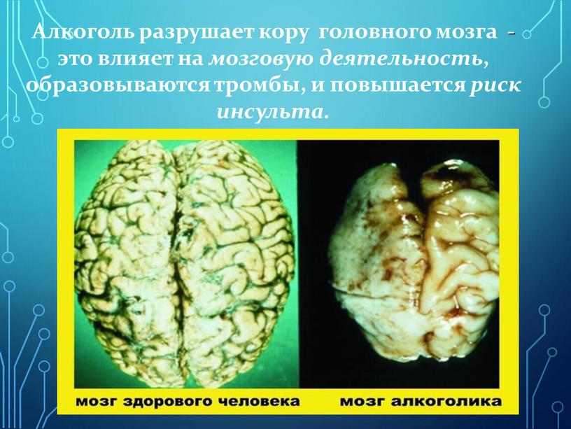 Алкоголь разрушает кору головного мозга - это влияет на мозговую деятельность , образовываются тромбы, и повышается риск инсульта