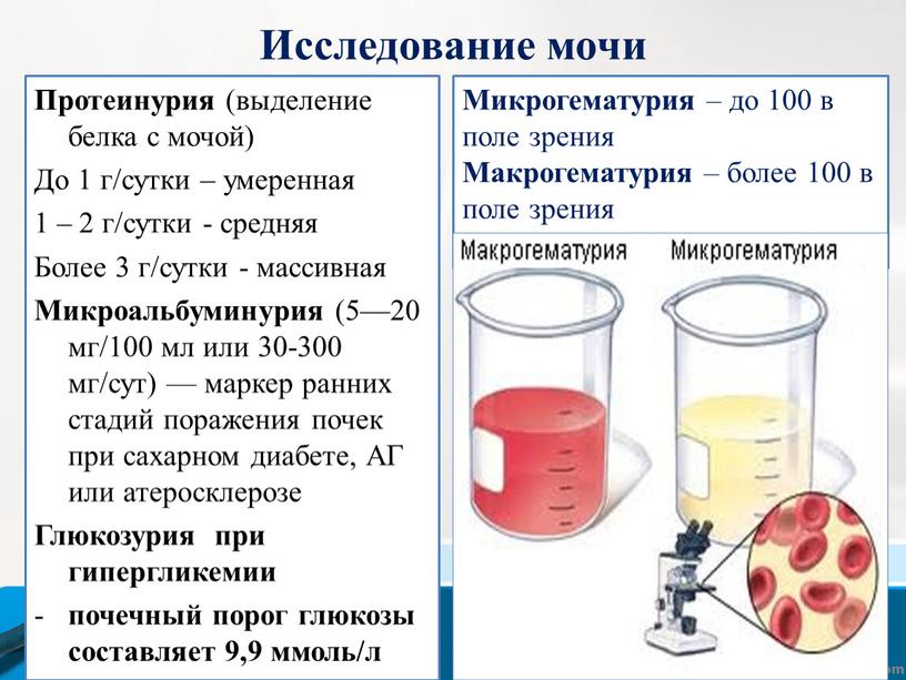 Протеинурия (выделение белка с мочой)