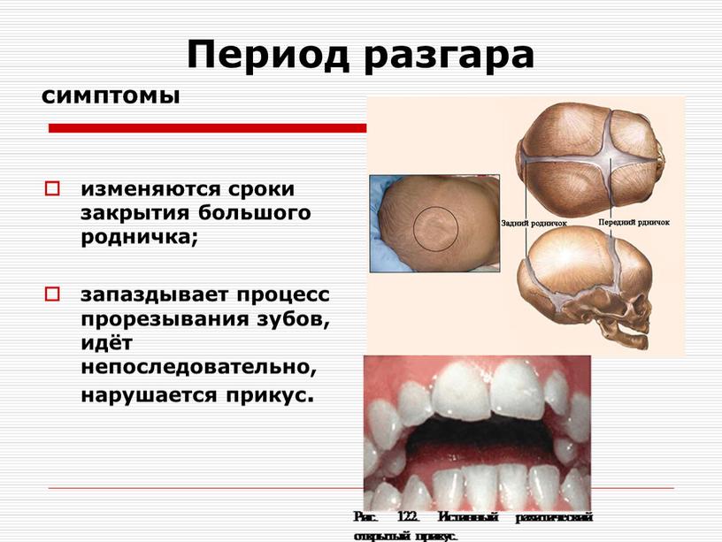 Период разгара симптомы изменяются сроки закрытия большого родничка; запаздывает процесс прорезывания зубов, идёт непоследовательно, нарушается прикус